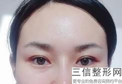 切开式双眼皮的价格，切开法双眼皮大概要多少钱