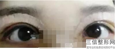 切双眼皮医院哪里好，割双眼皮哪家医院比较好