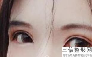 去眼袋眼纹的小偏方,怎样去眼纹眼袋