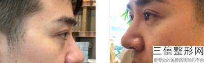 全切双眼皮多少钱，去皮去脂全切双眼皮大概多少钱