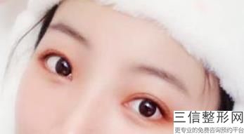 全切双眼皮多少钱，去皮去脂全切双眼皮大概多少钱