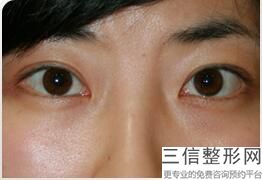 全切双眼皮价格,韩新鸣全切双眼皮价格