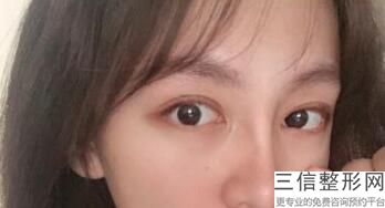 全切双眼皮价格，上海全切双眼皮多少钱