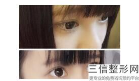 全切双眼皮价格，做双眼皮多少钱全切