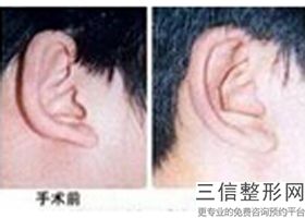全自体耳软骨隆鼻梁，全自体耳软骨隆鼻 天之美
