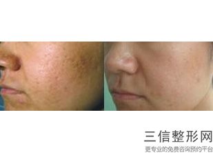 热玛吉一般多少,眼部做热玛吉多少钱