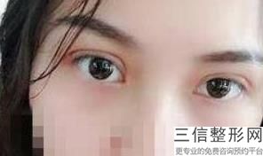 热天做双眼皮手术效果好吗，双眼皮手术效果好么