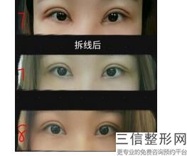 热天做双眼皮手术效果好吗，双眼皮手术效果好么