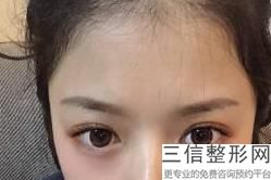 适合做双眼皮的季节，双眼皮在哪个季节做好