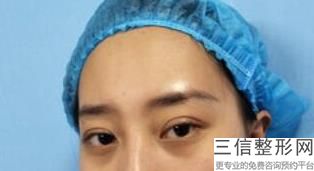 双眼皮好看吗，做双眼皮做哪个好