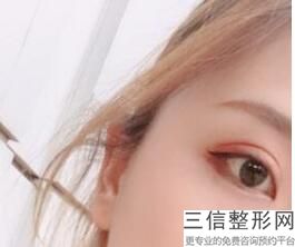 双眼皮什么季节做合适，这个季节适合做双眼皮吗