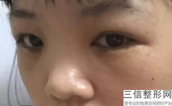 双眼皮手术到底疼不疼，做双眼皮手术很痛吗