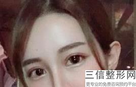 双眼皮手术到底疼不疼，做双眼皮手术很痛吗