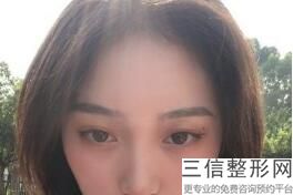 双眼皮手术价格,双眼皮手术的多少钱
