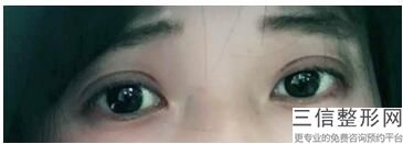双眼皮手术价格，做双眼皮手术需要多少钱呢