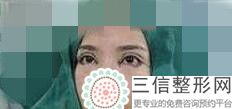 双眼皮手术哪个医院做的比较好,义乌做双眼皮手术哪家医院好