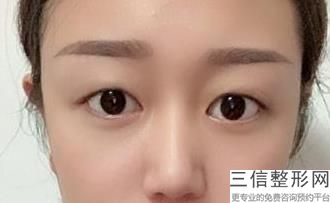 双眼皮手术失败能修复吗，双眼皮做失败了还能修复吗
