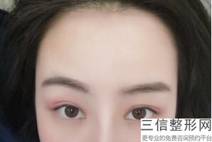 双眼皮手术有危险么,做双眼皮手术安全吗