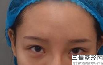 双眼皮手术有危险么,做双眼皮手术安全吗