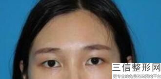 双眼皮修复医院推荐，国内做双眼皮修复良好的专家和医院在哪里