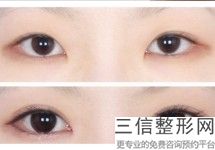双眼皮修复较好时间，双眼皮修复大概多少钱呢