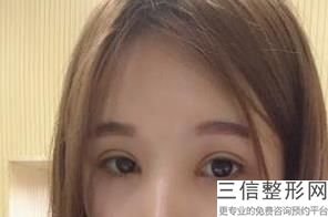 双眼皮修复较好时间，双眼皮修复大概多少钱呢