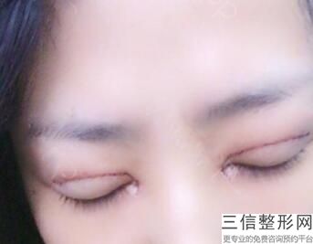 双眼皮整形医院，哪家美容医院做双眼皮好