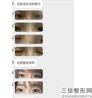 双眼皮做埋线的好还是切开好，双眼皮是切的好还是埋线好