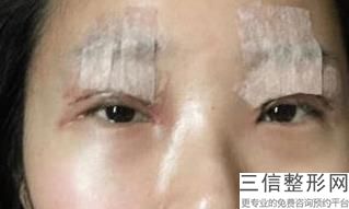 我想做双眼皮请问哪个医院比较好，哪家做双眼皮比较好的医院