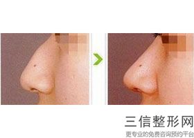现在做隆鼻的人多吗，现在做隆鼻手术会不会有什么