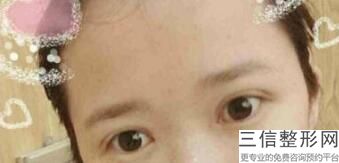 眼部整形手术的价格，眼部整形手术费用多少