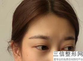 眼部整形手术的价格，眼部整形手术费用多少