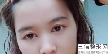 眼部整形手术的价格，眼部整形手术费用多少
