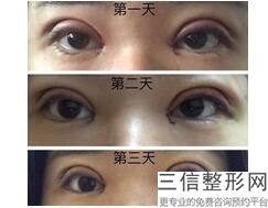 养生堂去眼袋的小妙方，北京养生堂专家讲怎样去眼袋