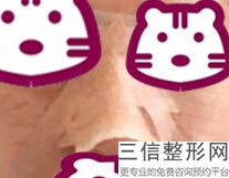 医院隆鼻需要多少钱，隆鼻隆鼻需要多少钱
