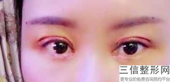 怎样做双眼皮好看，双眼皮怎样做好