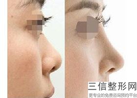 整形隆鼻医院好，隆鼻整形手术医院哪个好