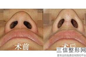 整形医院隆鼻哪里好，隆鼻整形医院那里好