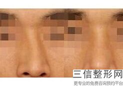 做个隆鼻手术要多少钱，做一个隆鼻手术要多少钱
