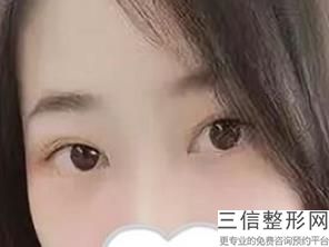 做个埋线双眼皮大概要多少钱，做一个双眼皮埋线多少钱