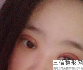 做个双眼皮大概多少钱呀,做个双眼皮得多少钱