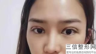 做个双眼皮得好多钱，做好的双眼皮多少钱