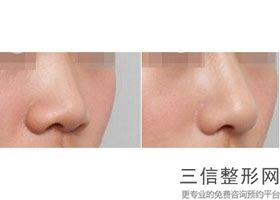 做假体隆鼻的价格一，假体隆鼻隆鼻价格