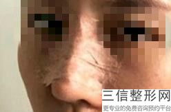 做假体隆鼻取出多少钱，做假体隆鼻取出线雕视频