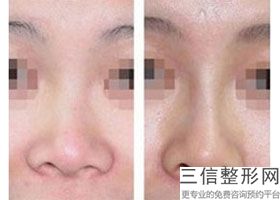 做假体隆鼻取出多少钱，做假体隆鼻取出线雕视频