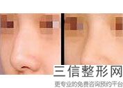 做假体隆鼻术，假体隆鼻隆鼻好吗