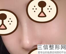 做假体隆鼻整形价格，假体隆鼻手术价钱