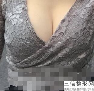 做假体隆胸的价格，做假体隆胸多少钱呢