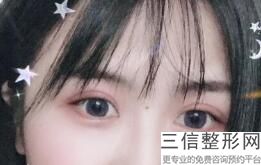 做开眼角哪里好,开眼角到底好不好