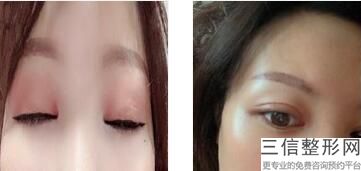 做开眼角哪里好,开眼角到底好不好